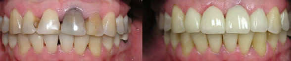 Before and after: Porcelain Crowns