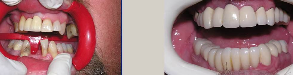 Before and after: Full Mouth Rehabilitation