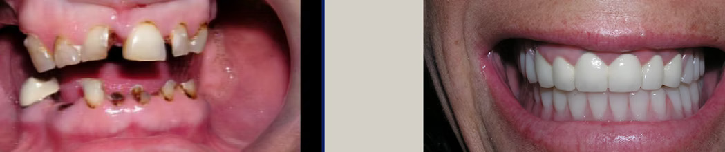 Before and after: Full Mouth Restoration After Tooth Loss from Drug Use