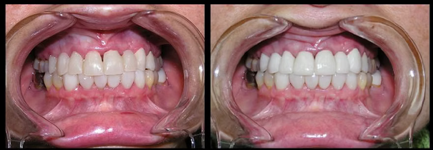 Before and after: Full Bridge